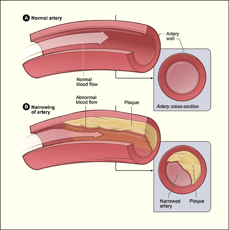 Атеросклероз - это заболевание, при котором налет в ваших артериях накапливается